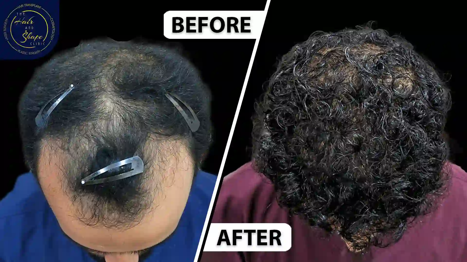 Hair Transplant result1